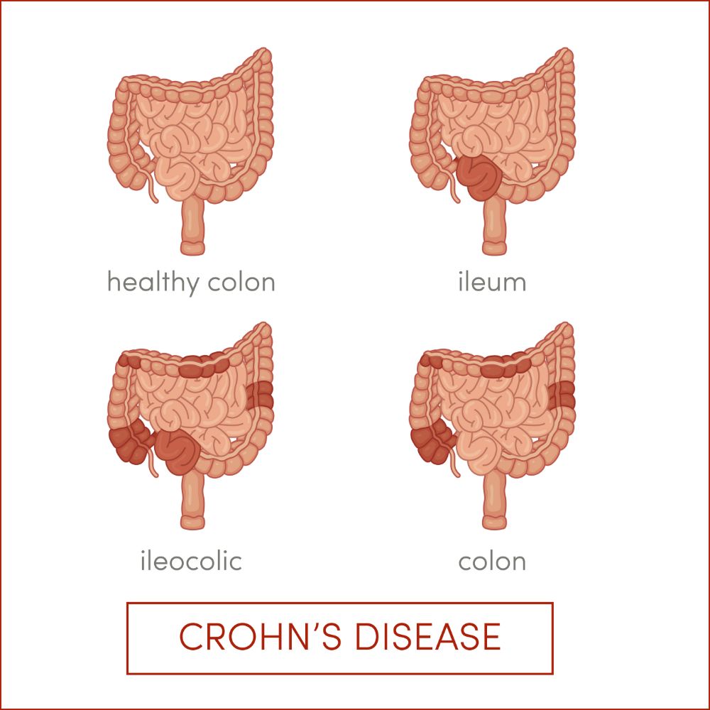 Τι είναι η Νόσος CROHN και πως αντιμετωπίζεται